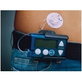 Bomba de Infusão Intratecal